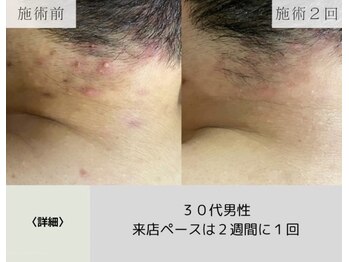 ボータン 恵(Beau Temps)/ハーブピーリング