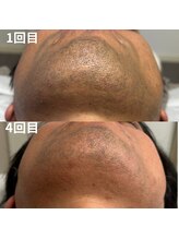 ヒダマリ 新屋敷店(Hidamari)/ヒゲ脱毛4回でこの効果