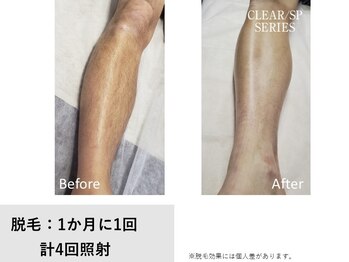 ベルフィオーレ(bel fiore)の写真/当店人気メニュー足脱毛【初回￥4.200 2回目から一生500円引きで￥3.700】初めての方にもオススメです！！