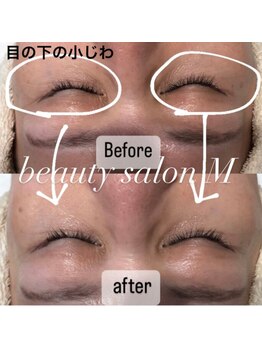 エム(M)/シワケアにはこれが最強!!