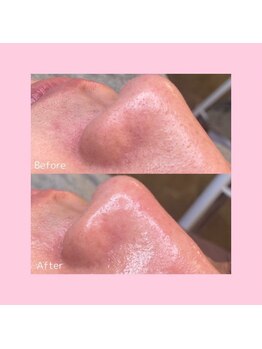 ホワイトラボ 名古屋栄(White labo)/【施術例】ハイドロフェイシャル