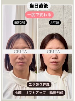 セリア(CELIA)/小顔矯正　ドライヘッドスパ