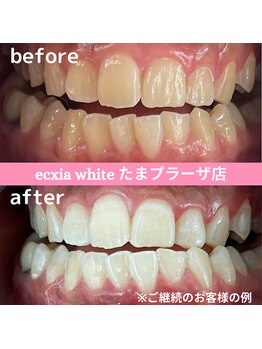 エクシアホワイトニング たまプラーザ店/ビフォーアフター