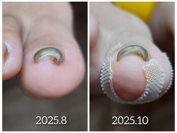 【巻き爪】爪溝の掃除を入念に