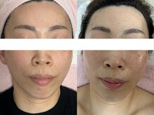 シミケア専門店 SAKURA 平塚店/ハーブピーリング