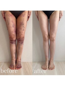 シンシアリー 広瀬通店(Sincerely)/before→after【脚】