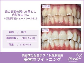 クレア(Crea)/【ホワイトニング症例写真】