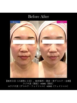フルオール(FRUOR)/巡り&エイジングケアで肌質改善