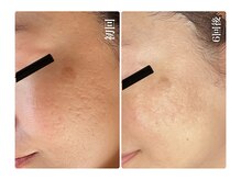 キレイ(KIREI)/初回→6回後