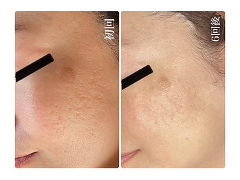 キレイ(KIREI)/初回→6回後