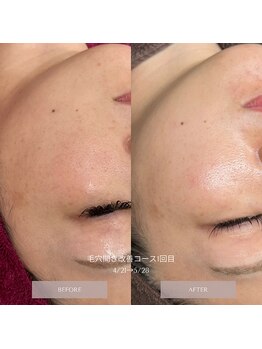 タグ 高知駅前店(Tug)/毛穴開き改善コース