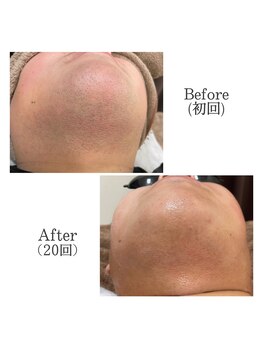 フォルチェ ゆめタウン広島店(Folche)/メンズ顔脱毛20回の結果