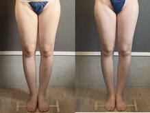 リジュ(Reju)/むくみスッキリ！ハイパーナイフ