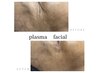 Plasma facial