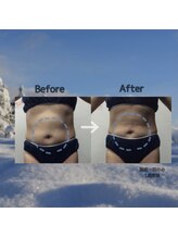 プリマプリート 各務原店/脂肪冷却1週間後！！