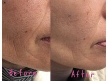 写真は70代の方です！濃厚エッセンス配合パック付◎シワ改善！