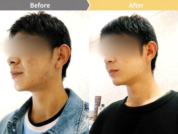 リリアンナ シェービング&エステの写真/男を磨け。トラブルだらけの男の肌を磨きまくる!メンズフェイシャルエステ70分¥3,800