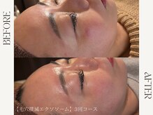 ルカ 北堀江(Luca)/毛穴レスなつるんと肌へ。