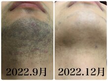 シア 静岡店(cia)/【ヒゲ脱毛】before→after