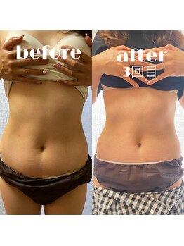 リリーボーテ 下北沢/インディバ施術（お腹）