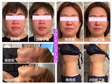 オハナ(OHANA)の雰囲気（知る人ぞ知る日本初上陸マシンで小顔も痩身も叶えます☆）