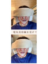 ソメイユ(Sommeil)/美容鍼ビフォーアフター.1