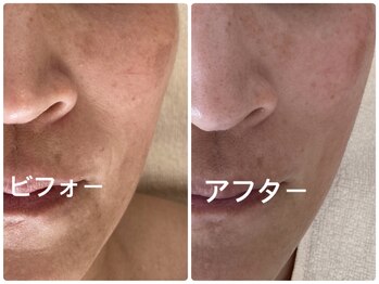 ノーブル シャット Noble Chate/肌育成!クスミ肌から透明肌へ