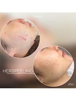モモ(Momo.)/お肌ケアにはハーブピーリング