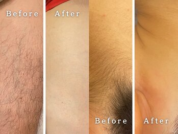 とんちゃん脱毛 新馬場店