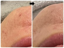 エフェクト 塚口店(effect)/Before After &nbsp;&nbsp;30代/3回目