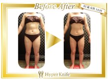 リライ(Re:Lai)/ ハイパーナイフで痩せる