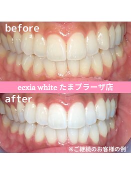 エクシアホワイトニング たまプラーザ店/ビフォーアフター