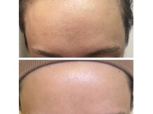 肌のキメ★スキンケア×インナーケア10日の変化