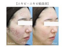 エピア 豊田店(Epia)/大人ニキビケア・赤み痕ケア