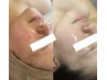 【ニキビ・肌荒れ改善】敏感肌対応◎毛穴洗浄×剥けないハーブピーリング