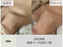 ボータン 恵(Beau Temps)/ハーブピーリング