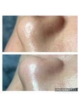 エヌ ドット ジュウイチ(N.11)/毛穴エクストラクション