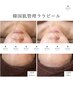 敏感肌OK 大人気 水光艶肌ララピール/ララマスク+¥3,300