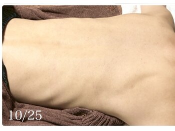 ピリナ 名古屋/【背中ハーブピーリング】症例