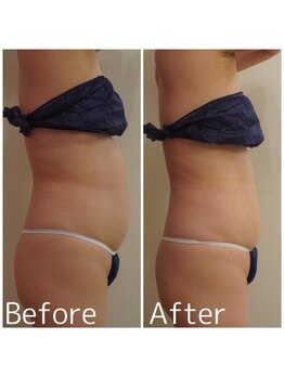 トータルビューティサロン クイーン(Queen)/40代以降の女性の痩身