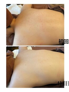 ピリナ 名古屋/【背中ハーブピーリング】症例