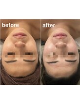 アトワ 新宿店(ATOI)/コルギ&リフトマシンで美顔に