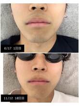 マリーローラン メンズルイズ(Marryrolan MensRuise)/メンズ脱毛【ヒゲ脱毛】経過