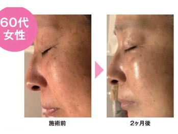 フー(fuu)/驚き幹細胞培養液導入で5歳若良