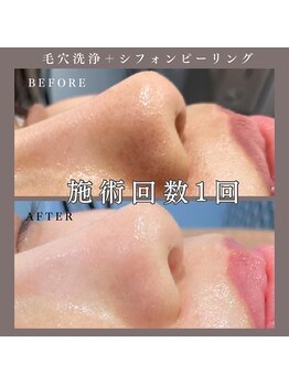 ベルミー(Bellmi)/毛穴洗浄×シフォンピーリング