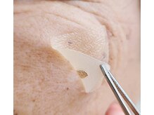 【WHITE LAB】韓国最新シミケア★7日でシミとさよなら♪