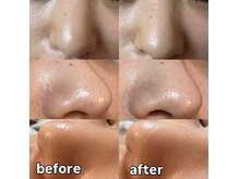 New 毛穴洗浄が登場！シミ、毛穴ニキビ対策へ