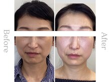 ブルースター/ほうれい線（40代）