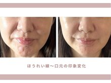 ロジワール(LOISIR)の雰囲気（小顔リフトアップ/小顔矯正/ほうれい線/むくみ/もたつき/）