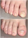 巻き爪改善ケア